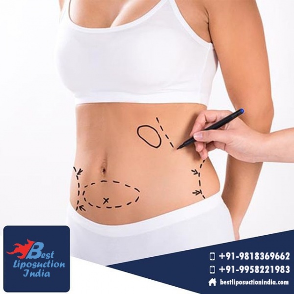 Liposuction Surgeons That Perform Cosmetic Surgery for Weight Loss