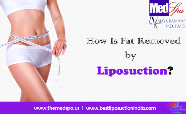 How Is Fat Removed by Liposuction?