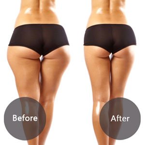 buttock liposuction