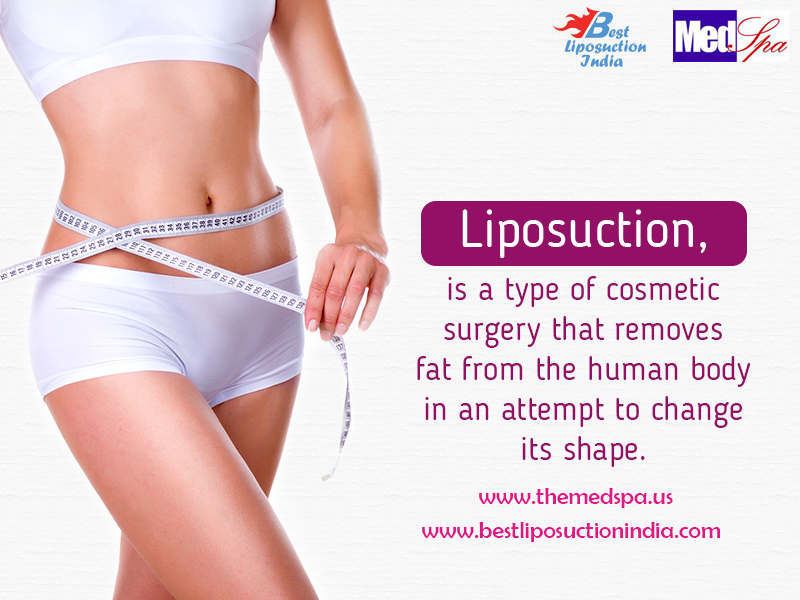 liposuction, liposuction surgery, liposuction surgeon, liposuction cost, liposuction in delhi, liposuction in india, cosmetic surgery, plastic surgeon, weight loss surgery in delhi, fat reduction, fat removal in india